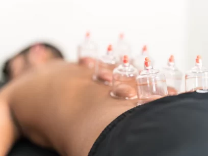 Cupping therapy applied on a male patient to relieve back pain