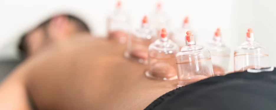 Cupping therapy applied on a male patient to relieve back pain