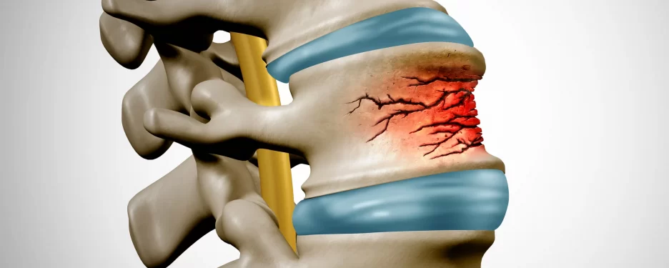 Stress Fracture in the body of a spinal vertebral