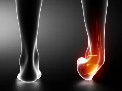 Right ankle suffering an inversion sprain affecting lateral ankle ligaments.