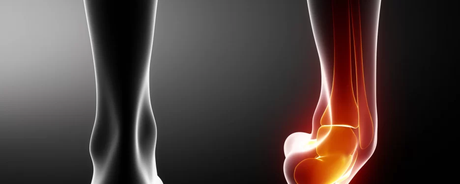 Right ankle suffering an inversion sprain affecting lateral ankle ligaments.